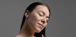 kobieta z trądzikiem