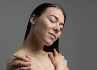 kobieta z trądzikiem