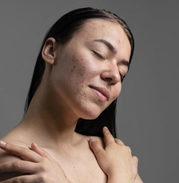 kobieta z trądzikiem