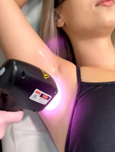 Depilacja laserowa bikini – jak wygląda?